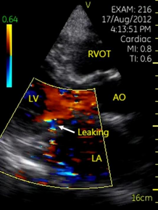 Figure 6: Left- type transposition of great artery performed. Left: Aorta and pulmonary artery paralleled in anterior and posterior direction in apical long-axis view of left ventricle. Right: Parasternal short-axis view of aorta showed that the aorta located in left and anterior of the pulmonary artery. AO= aorta, PA= pulmonary artery, LA= left atrium.