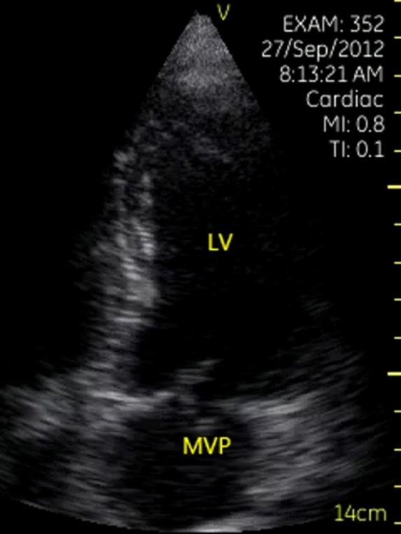 Figure 7: Interventricular septal defect. Parasternal left ventricular long-axis view showed a turbulent flow from left ventricle to right ventricle through the interventricle spetal defect. VSD= interventricular septal defect, LV= left ventricle, LA= left atrium.
