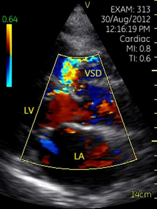 Figure 9: Pseudo arterial aneurysm after Bentall procedure 3 years in patient with Behçet's disease. Left: Parasternal left ventricular long-axis view. Right: Parasternal short-axis view of aorta. PAA= pseudo arterial aneurysm, LV= left ventricle, LA= left atrium.