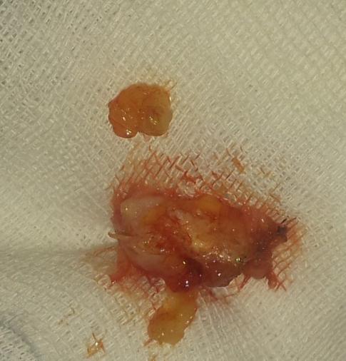 Figure 2: Image showing the excised ganglion cyst.