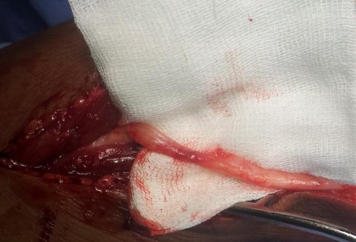 Figure 3: Image showing constricted part of the ulnar nerve by ganglion.