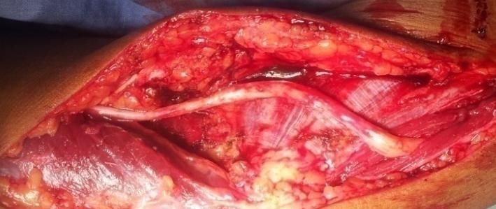 Figure 5: Anterior transposition of the ulnar nerve.