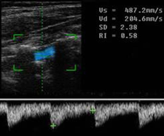 Figure 1: Color Doppler view of the normal vertebral artery at the level of C3-C6.