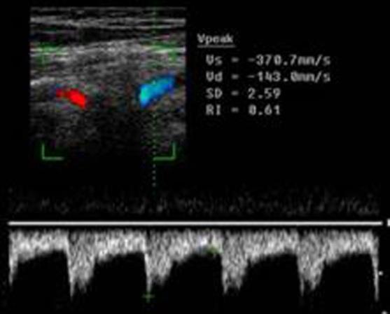 Figure 4: Doppler spectrum of the blood flow at level of C3-C4 in a patient with instability of C3. At the level of C3-C4, the direction of the blood flow is different - indicated by different colors.