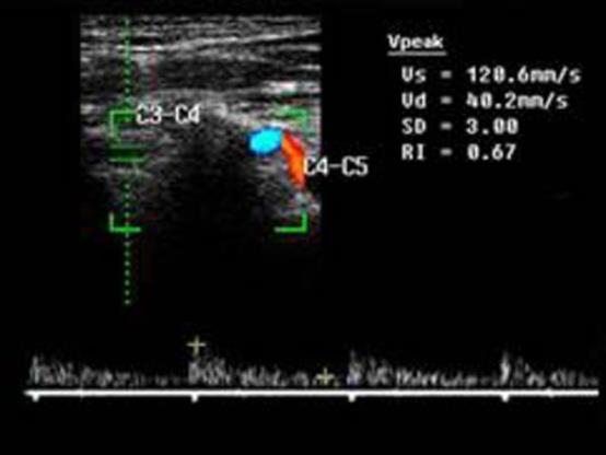 Figure 5: Doppler spectrum of the blood flow in second segment of the vertebral artery at the level of C3-C4 in a patient with uncovertebral arthrosis and C3 instability at a flexion of the neck. The Vs decreased to 12 cm/c, RI increased to 0,67.