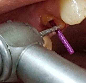 Figure 7: Temporary post crown. For post space preparation the enlargement of the canal was done using Peeso Reamers (sizes 1 to 3). Minimal enlargement and shaping of the canal is advised during post preparation due to anatomical considerations including thin mesio-distal dimensions and proximal root invaginations [12]. The residual cement in the post space was removed and the prepared space was cleaned with mouth wash. The inner surface of the old metal ceramic crown was cleaned using a slow speed number 6 round bur (SS White Burs, Inc, USA), cutting through bulk of the fractured tooth fragment and the old remaining composite build up within the crown moving from center outward. A care must be taken to prevent the contact between the rotating bur and the inner surface of the crown [13]. After three weeks the healing of the gum related to the gingiva was well improved .Once selecting an appropriate size of plastic post (Para-Post, Whale dent International, New York, N.Y.), it was inserted into the prepared root canal. The length of the post was adjusted by cutting with a bur (Figure 8) so it did not interfere with the inner surface of the crown which may compromise accurate seating and appropriate occlusion.