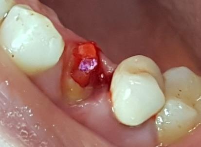 Figure 8: The plastic post was adjusted by cutting. After applying a layer of lubricant to the tooth structure an autopolymerizing acrylic resin material (Duralay, Reliance Dental Mfg Co, Alsip, Ill.) was used to rebase the plastic post and to coatits coronal part to ensure better adaptation to the tooth flared canal and pulp chamber structure (Figure 9).