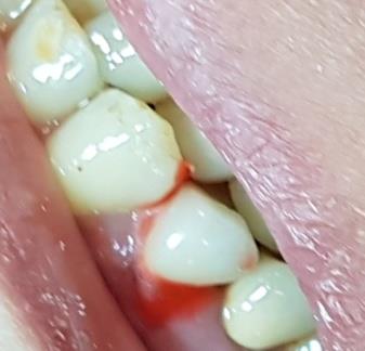 Figure 9: The plastic post was rebased with duralay resin.