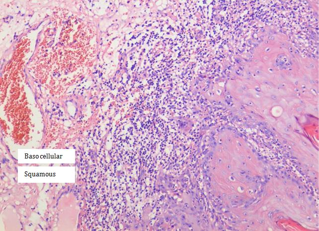 Figure 2: Invasion area of a well differentiated squamous cell carcinoma by the lingual mucosa in which it is noted infiltration of peritumoral stroma with immune cells” (Hematoxylin-Eosin staining [3]. Well differentiated squamous cell carcinomas contained well differentiated squamous cells, arranged as islands with different shapes and sizes, with keratinous pearls inside, determined by a process of „neoplastic maturation”. Inside the keratinous pearls, cells were acidophil with pyknotic nuclei and karyolysis, while the rest of the cells had nuclei of different shapes and sizes, bigger than normal epithelium’s nuclei. Many cells had polyedral aspects with intercellular spines (Figure 2).