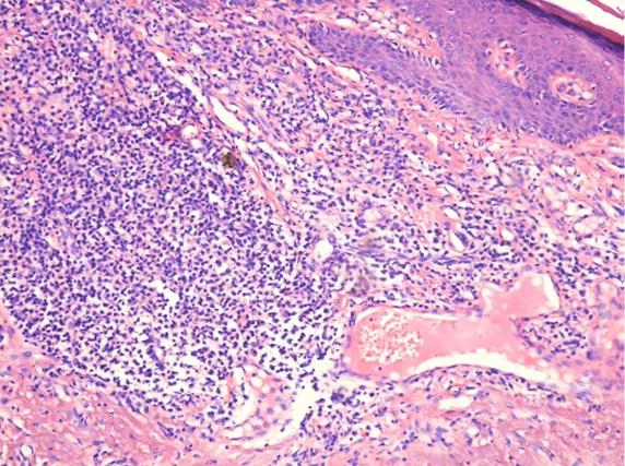 Figure 5: Well differentiated lip carcinoma with squamous cells with reshuffled stroma, particular connective tissue, congested vessels and inflammatory infiltrate (Hematoxylin-Eosin staining) [3]. Immediate after the rupture of basal membrane, and the invasion of cancer cells into the underlying connective tissue, it shows up an inflammatory reaction, leading to the formation of a particular granulation tissue, which matures into tumoral stroma (Figure 5). In this tumoral stroma, under the induction of inflammatory and angiogenesis factors, will form a rich vascular network that will ensure the proliferation of the tumor (Figure 6).