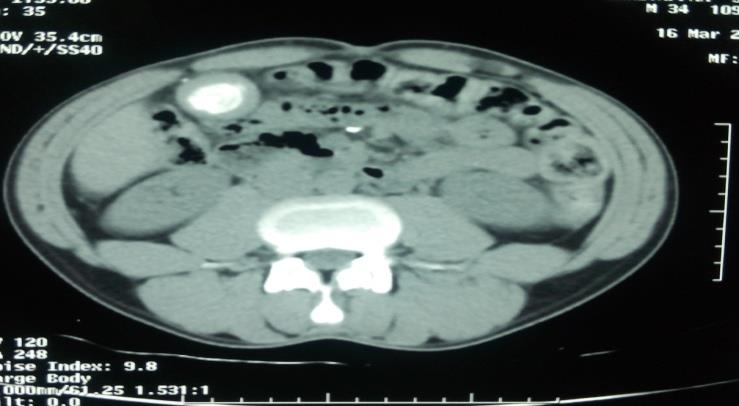 Figure 1: Contrast computed tomography abdomen showed a well defined round laminated calcified mass of 3.2X 2.7cm seen in hepatic flexure.