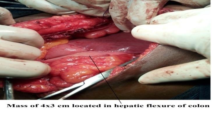 Figure 3: Intra operative picture showed mass of 4x3 cm present in hepatic flexure.
