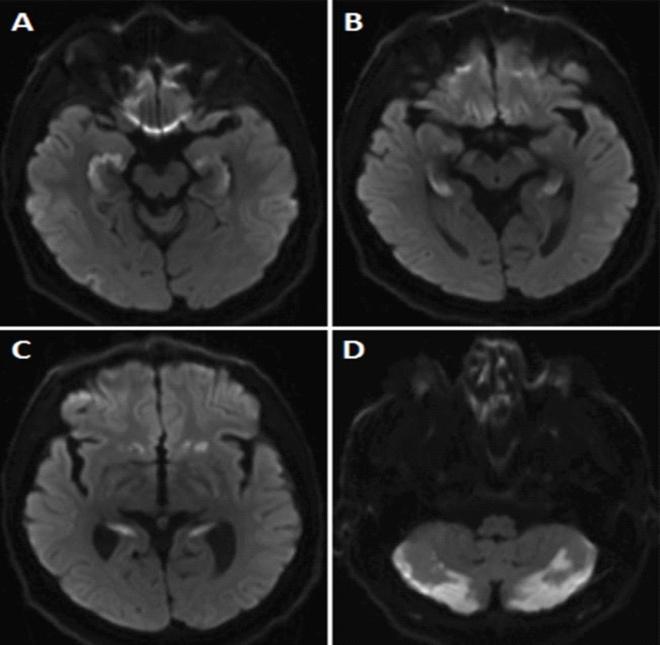 Figure 2: DWI images of the brain demonstrate “symmetric pattern of restricted diffusion” that correlated with areas of hyper intensities on FLAIR images (not presented) “Courtesy of Sherwani et al., 2015” [4].
