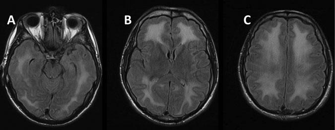 Figure 7: 38 y/o following metamphetamine use with FLAIR imaging showing confluent signal hyper intensity of the supratentorial white matter “Courtesy of Mobius et al., 2014” [18].