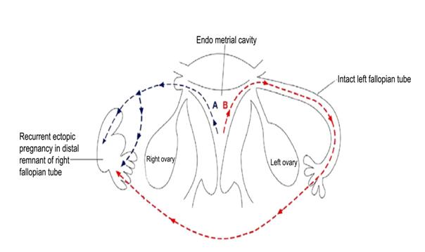 Figure 2: Recurrent tubal pregnancy following partial proximal salpingectomy may have occurred following passage of spermatoza or the fertilized egg from the endometrial cavity to the distal remnant of the right fallopian tube (A) or passing spermatoza through the intact left falloian tube and through pouch of douglas (B). Given the uncertain nature of the mechanism for ipsilateral ectopic in tubal remnant, selecting a method for prevention is quite difficult. However taking care of few things may help in decreasing the incidence like tubal stump should be kept of minimal length while performing salpingectomy. Beside this complete peritonisation of the corneal incision and advancement of the round and broad ligament over the uterine cornua (modified Coffey technique) and cauterization of the remaining stump may have promising role [14].