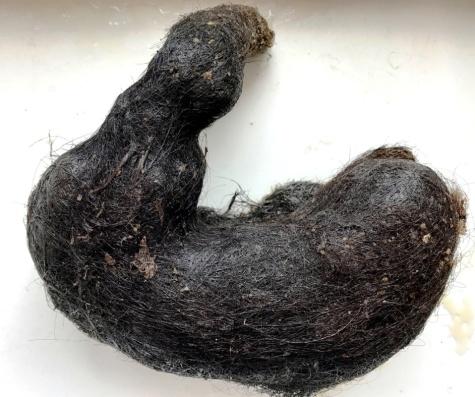 Figure 1: Giant Trichobezoar reflecting the shape of the stomach.