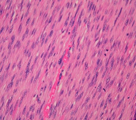 Figure 2: The tumor was made by fascicles of spindle shaped cells with mild to moderate nuclear atypia and numerous mitosis (HESx20).