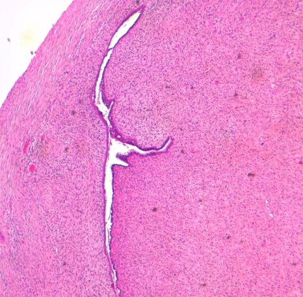 Figure 3: Benign dilated endometrial glandular element with predominate mesenchymal component (HEx5).