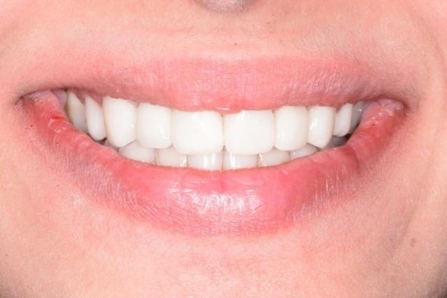 Figure 10: Extra-oral view after adhesive cementation.