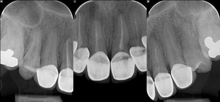Figure 2: Pre-operative radiographs showing periapical periodontitis related to teeth #12, 11, 21 & 22.