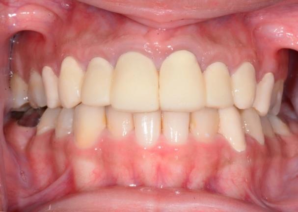 Figure 7: interim crowns showing improved gingival condition.