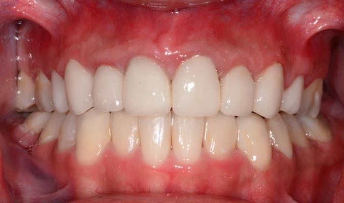 Figure 9: Frontal view showing final result after cementation.