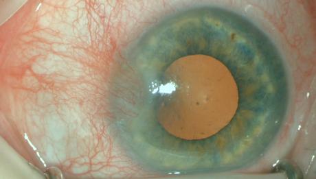 Figure 1: Nasal pterygium on the left eye. The goal of treating pterygia is to restore ocular surface anatomy, restore or improve function, improve cosmesis, and alleviate all associated symptoms. Preventing the formation or progression of pterygia is by decreasing UV exposure. Eye protection by wraparound sunglasses and wide brimmed hats should be stressed to everyone [3]. For those who have already been diagnosed, they should be monitored with yearly serial photography. Medical management options include lubricants, anti- inflammatory topical agents such as NSAIDs or steroids. More recent strategies include cyclosporine 0.05% as a safe treatment for long-term anti-inflammatory treatment, while co-managing dry eye syndrome symptoms that can be caused by pterygia. Current studies are being done to evaluate the efficacy of oral doxycycline, as it serves as an inhibitor of the pathogenesis cascade. Due to irregular corneal changes caused by the pterygium, significant astigmatism may be induced [3]. In less severe cases, the with-the-rule astigmatism or against-the-rule astigmatism can be managed with spectacles or soft toric contact lenses. In advanced cases, the irregular corneal astigmatism can be managed with other specialty contact lens options. Pterygia may require surgical management in cases of discomfort, cosmesis, or obstruction of vision. The goal of pterygium treatment is avoiding recurrence, but complication rates and cosmetic results are also weighed [6]. The gold standard for surgical management of pterygia is excision with the use of autoconjunctival reconstructive grafting. This management provides a low recurrence and complication rate. Recent studies have shown a decrease in the already reduced rate by using fibrin glue instead of sutures. Alternatives to fibrin glue include never techniques, such as autologous blood and electrocautery pen, yet both need larger clinical trials. A related procedure is the limbal conjunctival autograft, in which limbal tissue is included in the graft source and then transferred to the destination [6]. It is hypothesized that this will prevent the residual tissue from proliferating with faster healing with the addition of limbal stem cells [6]. Although limbalautografts have a lower recurrence rate in comparison to conjunctival grafts, the complications are more severe and the procedure takes longer. Another adjunct therapy commonly used after a bare scleral excision is to cover it with an amniotic membrane. Amniotic membrane has antinflammatory properties as it promotes epithelial growth and suppresses transforming growth factor (TGF-β) signaling fibroblast suppression. Amniotic membrane recurrence rates are high compared to conjunctival autografts, although newer techniques with steroid injections have reported lower recurrence rates. Other newer trends include the use of cyclosporine post-operatively to reduce inflammation, mitomycin C (MMC), and beta radiation to modify wound healing, as well as anti- VEGF/antiangiogenic therapy to induce vessel regression in pterygia. All excised pterygia should be submitted for histopathology examination due to 10-30% of specimens having unsuspected neoplastic cellular findings [3].