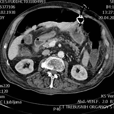 Figure 2: Abdominal CT, showing free intraperitoneal air and inner cuff of the PEG that is partially outside the gastric lumen. Discussion Some adults and children are unable to swallow or eat and drink enough. Insertion of a percutaneous endoscopic gastrostomy (PEG) tube may enable long-term feeding, fluid and/or medication administration. The procedure involves gastroscopy under sedation to identify tube placement site, place the tube and check it has been placed correctly. Serious complications include peritonitis and perforation of the colon. Frequent observations immediately after placement are essential. Complications can occur with the PEG placement, such as pain at the PEG site, leakage of stomach content around the tube site, and dislodgment or malfunction of the tube. Possible complications also include infection of the PEG site, aspiration (inhalation of gastric content into the lungs), bleeding and perforation (an unwanted hole in the bowel wall) [4]. With good nursing care, complications can be avoided or dealt with promptly [5]. PEG feeding will reduce morbidity and mortality in many such patients by reversing malnutrition. The increasing numbers of elderly patients with chronic diseases have resulted in an increased demand for PEG placement that has stretched resources. Many patients who are referred for PEGs are frail and the procedure is associated with complications. Careful management and support for the carriers in the community are essential. Not all patients benefit from PEG feeding [6].