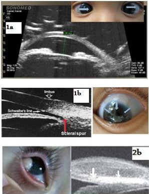 Figure 1: The probe orientation is marked by blue arrows. Figure 1a: the axial view of this case show the angle to angle width with shallow anterior chamber , closed angle and increased iridolenticular contact area. Figure 1b: The angle view with the structure of the normal angle; schwalb’s line (white arrow ) and scleral spur (the red arrow ). The most significant disadvantages of UBM are the need for immersion, the necessity of the supine position, and the need for patient cooperation during image acquisition. Recently, a disposable ultrasound probe covers eliminate the need for the supine position and insertion of a plastic shell during image acquisition [2]. Also, the Penetration depth of only 4-5 mm with Image quality that depends on plane of section, orientation of the probe, room illumination, fixation and accommodative effort, all may present minor inconveniences. In the normal eye, the cornea, anterior chamber, posterior chamber, iris, ciliary body, and anterior lens surface can be recognized easily (Figure 1b). The scleral spur is a landmark located where the trabecular meshwork meets the interface line between the sclera and ciliary body. The