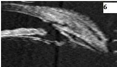 Figure 7: shows UBM findings in cases of uveitis. Figure 7a: Uveitis induced glaucoma with peripheral anterior synechiae (white arrow) and intact iris posterior pigmented epithelium (red arrow). Figure 7b: Ciliary body deposits and anterior vitreous deposits. Figure 7c: Numerous cells, peripheral anterior synechiae closed angle and iris granuloma with intact iris posterior pigmented epithelium. Marked oedema in the iris⁄ciliary body and numerous adjacent exu-dates. Marked oedema in the iris⁄ciliary body and numerous adjacent exu-dates.