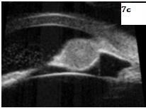 Figure 8: Typical UBM findings in a pigment dispersion syndrome are a widely opened angle, posteriorly inserted iris with posterior bowing, and increased iridolenticular contact. Pseudo exfoliation syndrome is associated with a thick anterior lens capsule and disintegrated zonules with nodules. After Trabeculectomy, fluid-filled spaces can be identified in the subconjunctival and sub-Tenon's spaces above the level of the episclera denoting a functioning bleb [3] (Figure 6). **Uvietis:** UBM can assess the retrolenticular and retroiridal space and detect ciliary membranes in cases of chronic hypotony [8] (Figure 7).