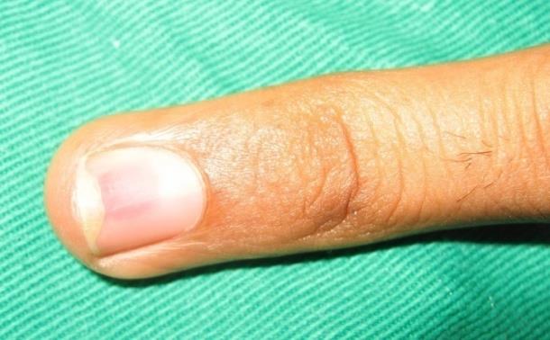 Figure 1: Bluish discoloration of nail in a case with subungual glomus tumor.