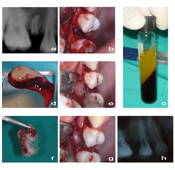Figure 1: a) Periapical radiography of residual root. b) Surgical access to proceed the residual root extraction. c) PRF procedure where shown the three phases. d) PRF clot were isolated and it cut in two parts. e) One part it was placed into the alveolar socket. f) The other part was performed an autologous barrier. g) The autologous barrier was placed to close the alveolar socket with PRF. h) Periapical radiography thirty days after surgery showed an alveolar socket fill with bone matrix.
