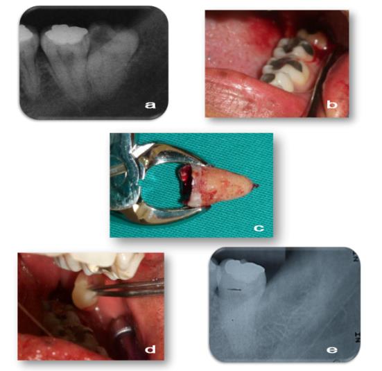 Figure 2: a) Periapical radiography of wisdom tooth.