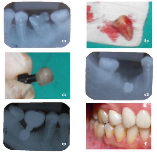 Figure 4: a) Periapical radiography of first inferior molar showed large coronal destruction with dental pulp compromise. b) Surgical access to proceed the molar extraction, it was present a fused roots. c) PRF procedure where performed and fibrin clot was placed around of dental implant. d) Dental implant with fibrin clot were placed into the alveolar socket reaching a primary stability less than 20N, fibrin clot and autologous barrier was done and was placed into the alveolar socket protecting the dental implant. e) Periapical radiography was taken fourth months after surgery showed a bone healing suggesting the osseointegration. f) Immediately was performed the rehabilitation with ceramic crown.