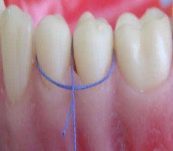 Figure 1: Suture is passed through the facial surface of papilla from outside to inside and looped around the lingual of the first neighboring tooth. Suture does not enter the lingual flap.