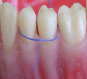 Figure 2: The suture is passed through interproximal area to facial surface and looped around the teeth next to the involved papilla.