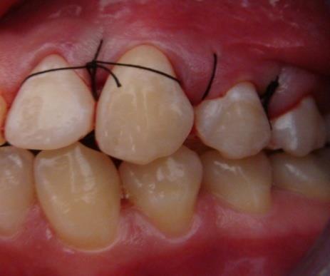 Figure 6: Clinical use of the new suture technique.