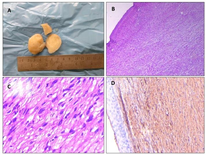 Figure 4: Spindle cells showed positive staining with S- 100 on immunohistochemistry.
