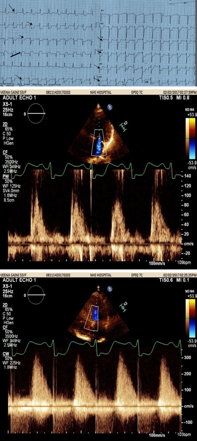 Figure 1: ECG showing sinus tachycardia with ST elevation in a VR (Big black arrow) and ST depression in leads I, II, III, a VF and V3-V6 (small black arrows).