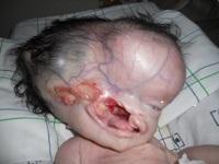 Figure 1: Polymalformative syndrome. The clinical examination had noted a polymalformative syndrome (Figure 1), including: a macrocrania, with a cranial perimeter at 48 cm (> 97th percentile), a labio- sphenoidal cleft. On the right eye: incomplete cryptophthalmos with the presence of an upper eyelid, without a palpebral fold and without an eyeball. In the left eye: aniridia.
