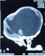 Figure 2: The cerebral CT scan showed a major hydrocephalus with a reduction of the cerebral parenchyma and confirmed the labio-sphenoidal cleft. No other abnormalities in within the clinical examination, abdominopelvic ultrasound and echocardiography were free from abnormalities. The karyotype was normal. The diagnosis of Fraser syndrome was based on two major criteria: cryptophthalmos and syndactyly and a minor criterion: the labio-sphenoidal cleft. The treatment of our patient required a multidisciplinary approach, she was not operable. The evolution was fatal after 3 months.