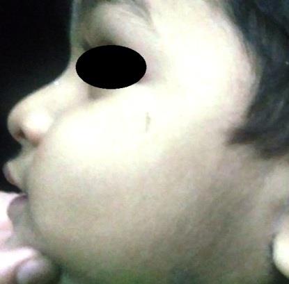 Figure 1: Complaints of recurrent swelling and pain over left parotid area.