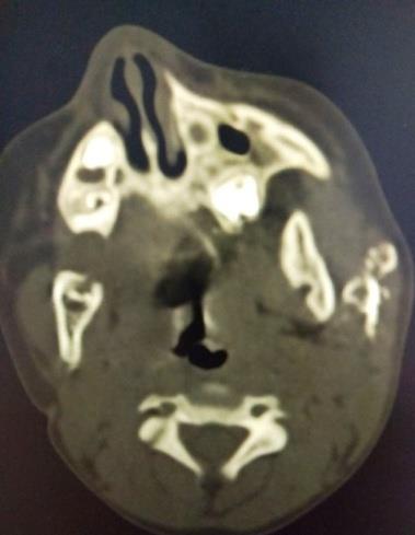 Figure 3: CT Sialography revealed dilatation of the main duct and the ductules.