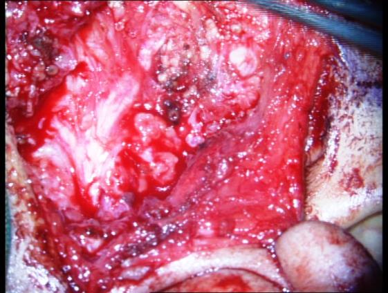 Figure 4: The pus was drained out and the stone was removed.
