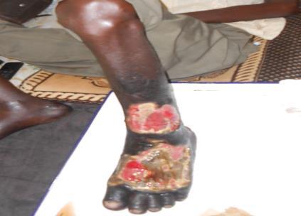 Figure 1: Multiple leg ulcer.