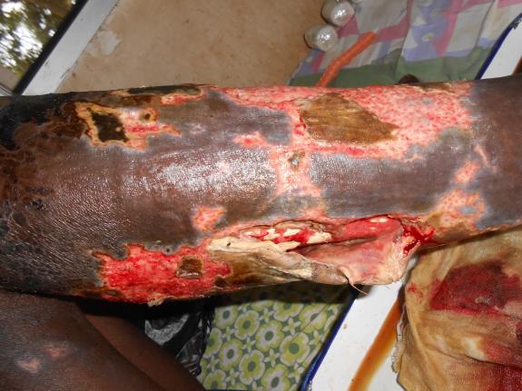 Figure 2: Suspected phagedenic ulcer.