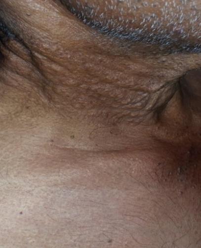Figure 2: Neck with inelastic thickened skin folds & papules.