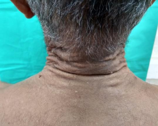 Figure 3: Inelastic skin over the posterior part of the neck.