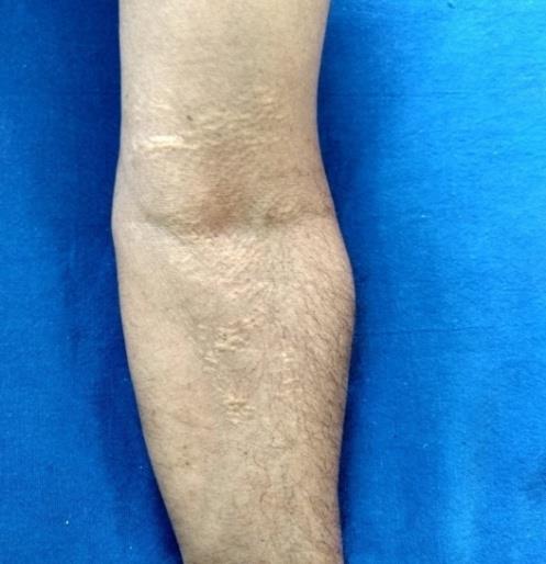 Figure 4: Yellowish papules & plaques over the cubital fossa.
